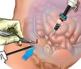 Colelitiasis: Diagnóstico y manejo especializado en la CDMX
