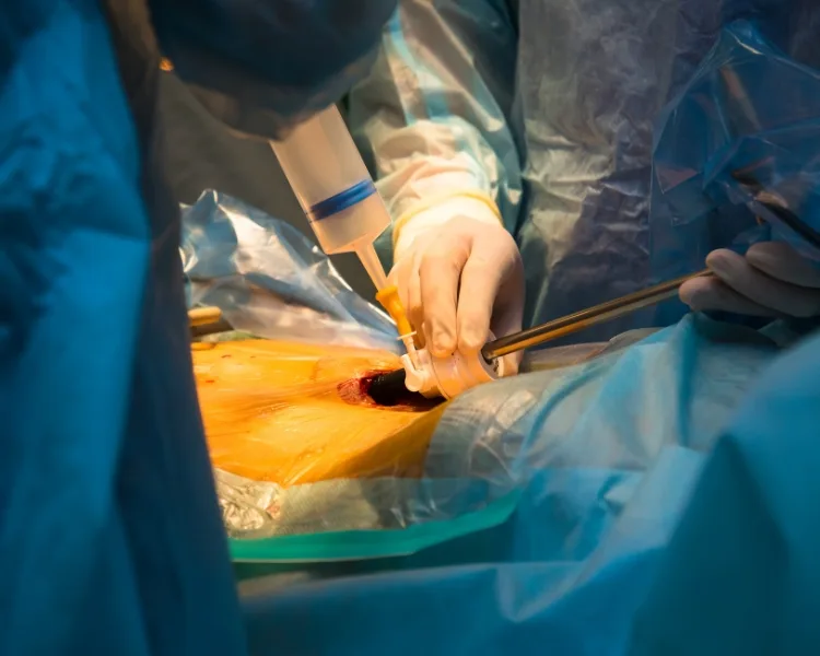 ¿Qué médico trata una obstrucción intestinal?